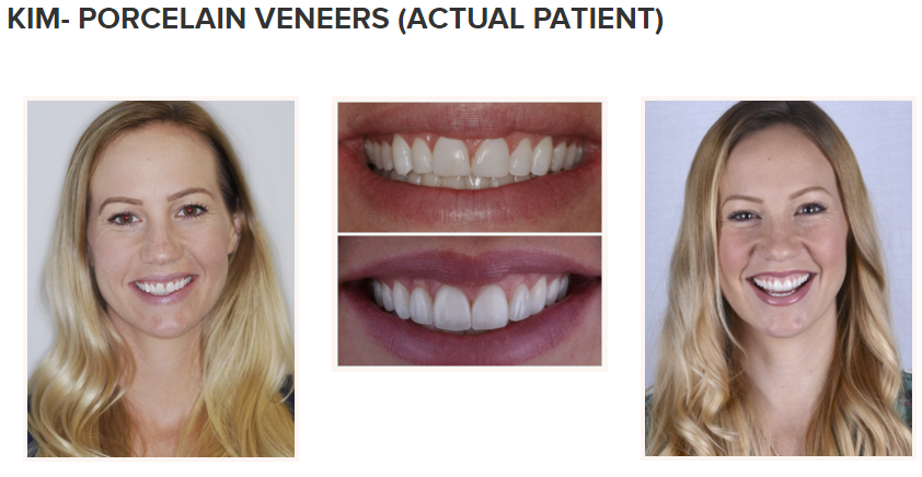 smile gallery - porcelain veneers