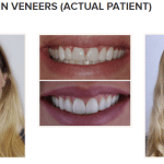 galería de sonrisas - carillas de porcelana