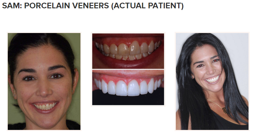 EHT Veneers 