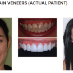 EHT Veneers 