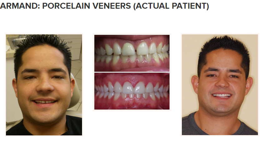 smile gallery - porcelain veneers