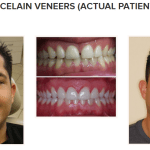 galería de sonrisas - carillas de porcelana