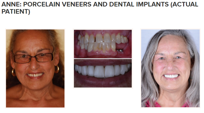 smile gallery - porcelain veneers and dental implants