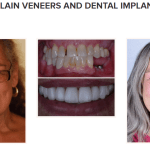 galería de sonrisas - porcelain veneers and dental implants