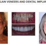 smile gallery - porcelain veneers and dental implants