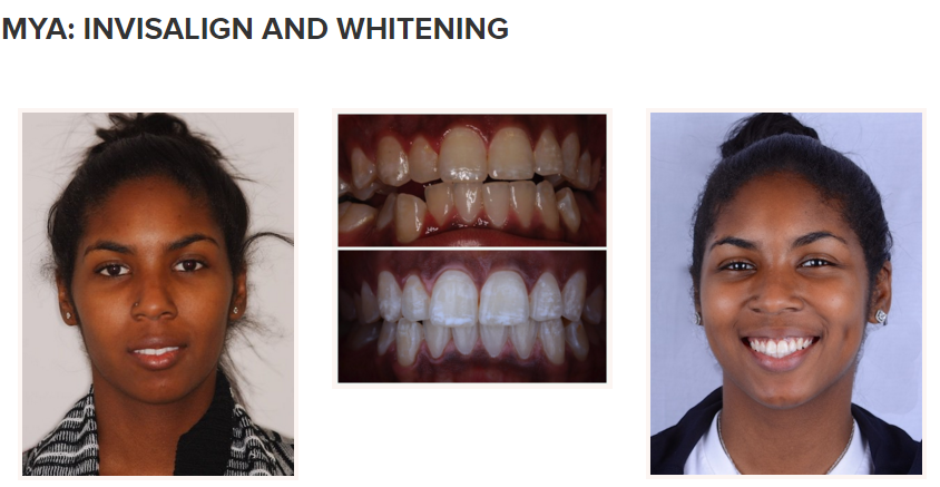 smile gallery - Invisalign and whitening 