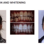 galería de sonrisas - Invisalign and whitening 