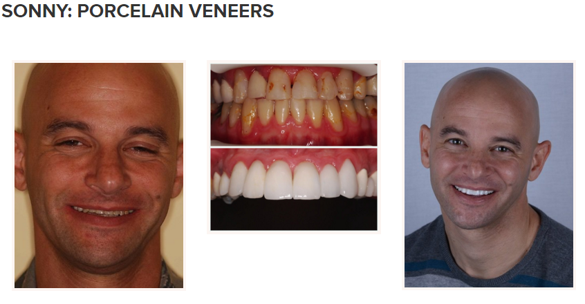 smile gallery - porcelain veneers