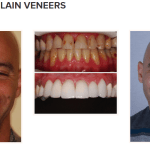 galería de sonrisas - carillas de porcelana
