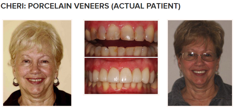 smile gallery - porcelain veneers