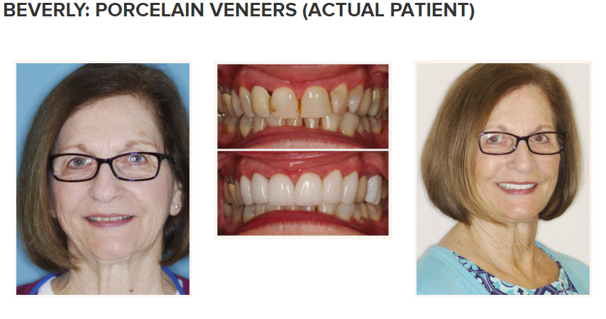 smile gallery - porcelain veneers