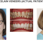 galería de sonrisas - carillas de porcelana