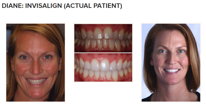 smile gallery - invisalign