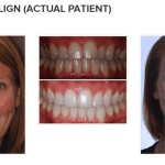galería de sonrisas - invisalign
