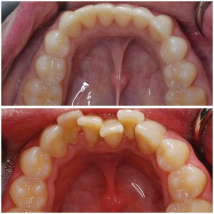 before and after Invisalign 