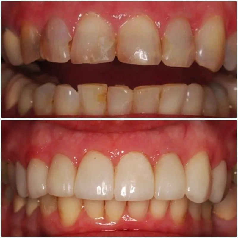 Cherrie Intraoral COL