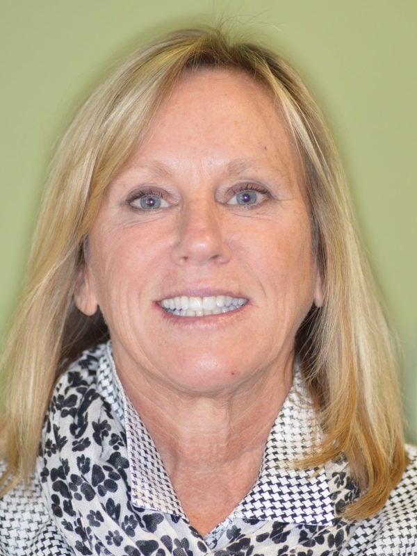 Sue before Invisalign and free whitening