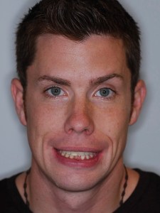 Albert before Invisalign 