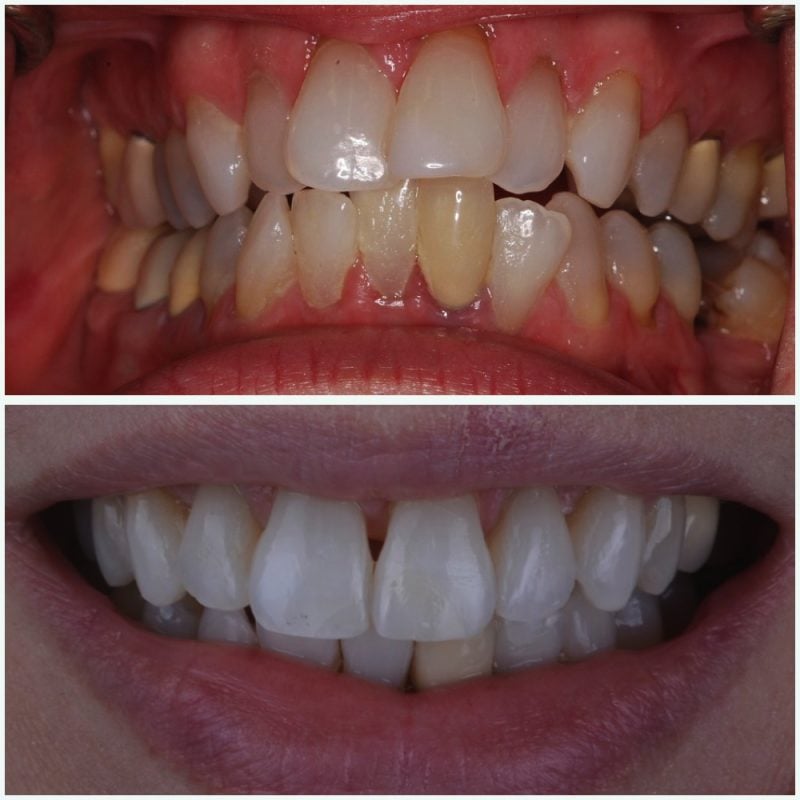 invisalign before after in egg harbor township