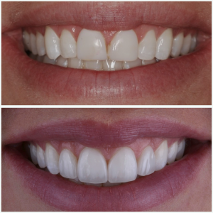 Kim's Georgeous smile after 4 porcelain veneers were placed by Egg Harbor Township Dentist, Dr. Erik Mendelsohn