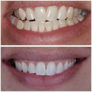 before and after Invisalign and free whitening