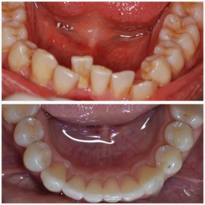 before and after Invisalign, whitening & bonding