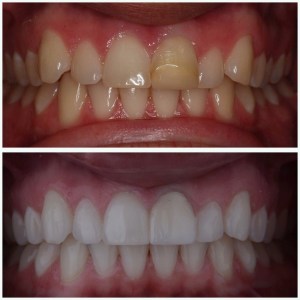 before and after Invisalign, whitening & single tooth veneer