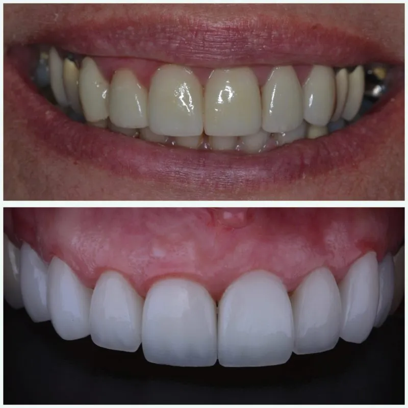 antes y despues carillas de porcelana