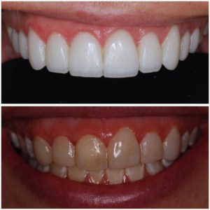 Before and after comparison of teeth whitening and restoration