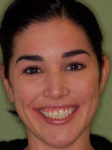 Woman Samantha Veneers before pic