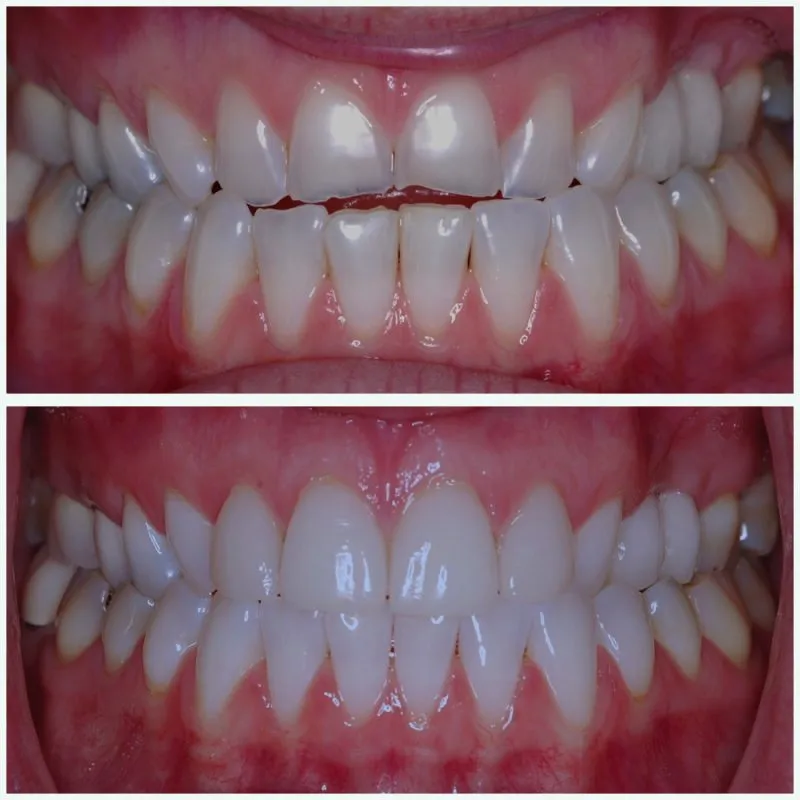 antes y despues carillas de porcelana