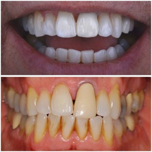 before and after Porcelain Veneers