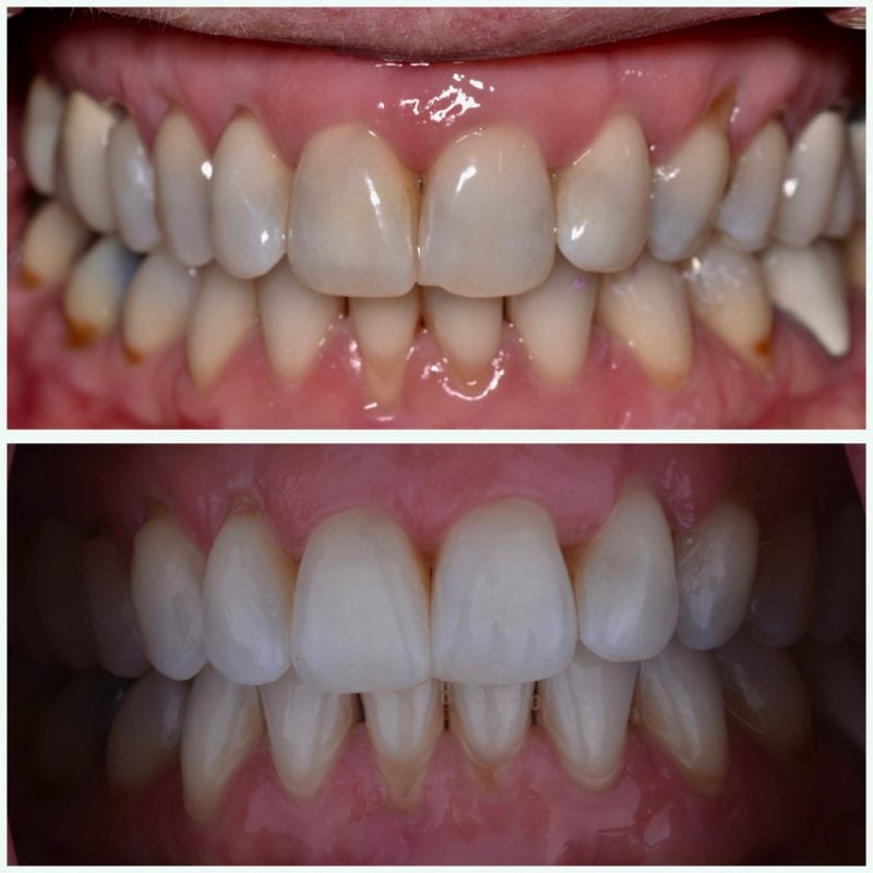 before and after Invisalign and free whitening