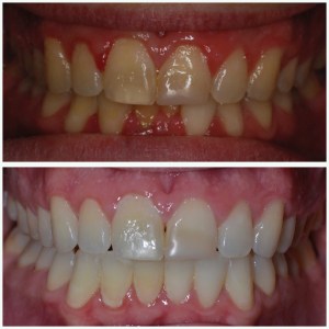 before and after Invisalign 