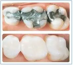 dental amalgam