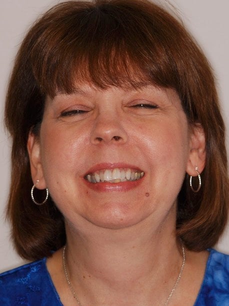 Diane before Invisalign & whitening 