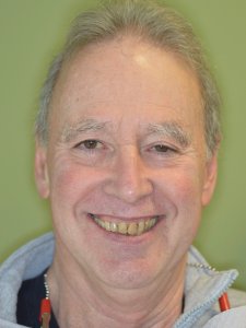 Male before Porcelain Crowns
