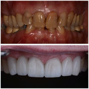 before and after Porcelain Crowns
