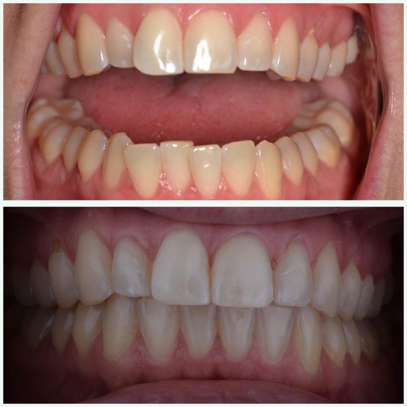 Lauren G. Egg Harbor Township New JErsey Dentist Invisalign patient before after