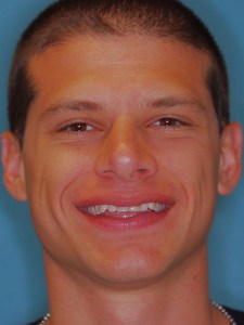 Mike before Invisalign, whitening & single tooth veneer