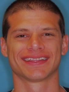 Mike before Invisalign, whitening & single tooth veneer