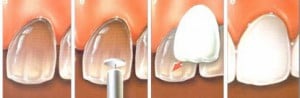 porcelain-veneer-300x98