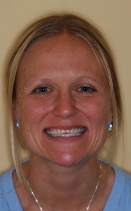 Woman before porcelain veneers