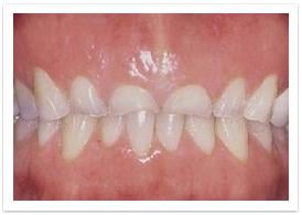 bruxism