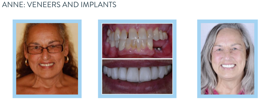 smile gallery - veneers and implants