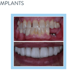 galería de sonrisas - veneers and implants