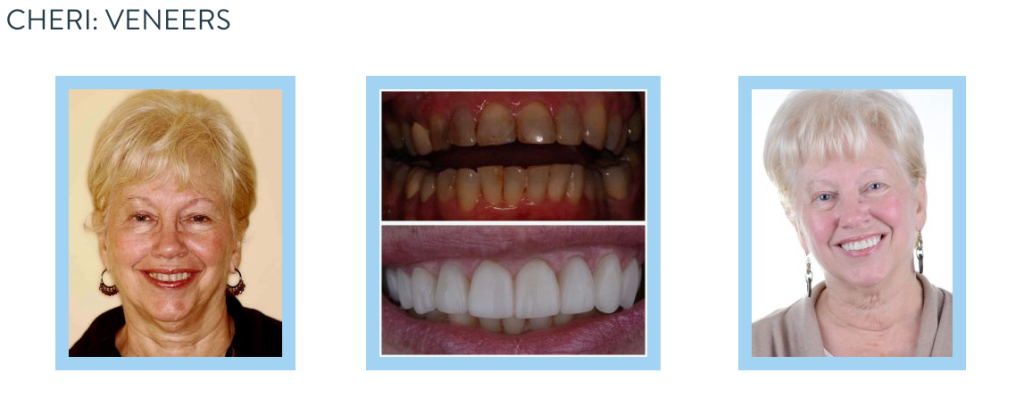 smile gallery - veneers