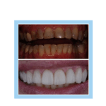galería de sonrisas - chapas