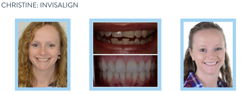 smile gallery - Invisalign