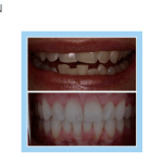 galería de sonrisas - Invisalign 
